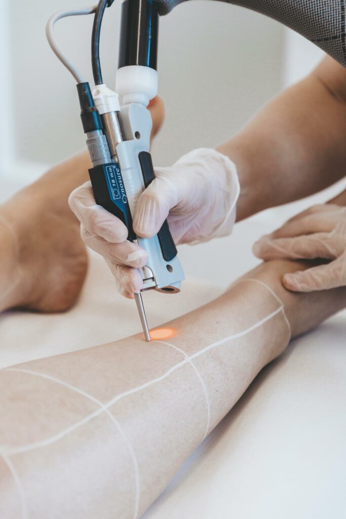 Cynosure Elite iQ laser treatment at EliteMD Aesthetics in Markham