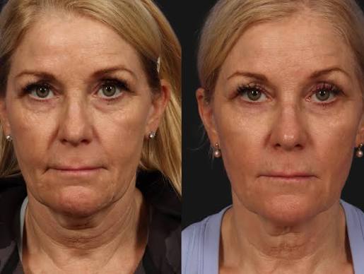 Before and after Morpheus8 — smoother, firmer facial skin
