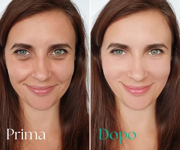 Before and after Morpheus8 — refined texture and even tone