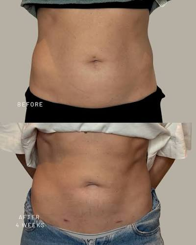 Before and after QuantumRF on the abdomen at four weeks